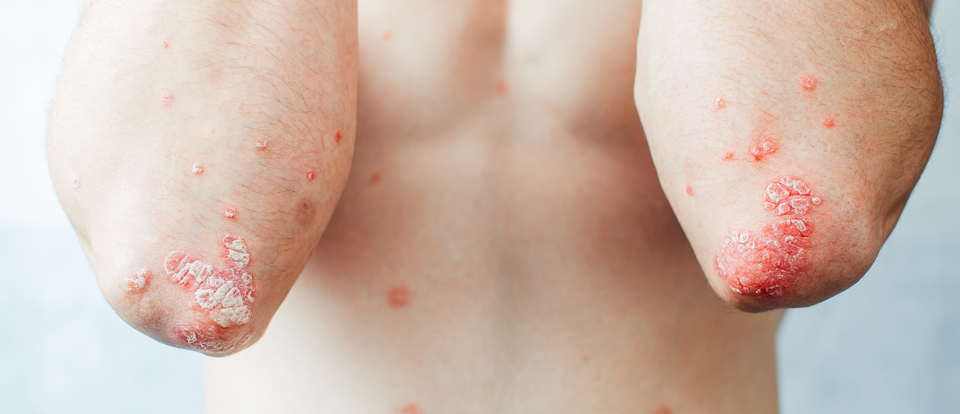 PSORIASIS | DERMAPOLE